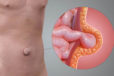 Cirurgia Hérnia Umbilical - IZB Gastro