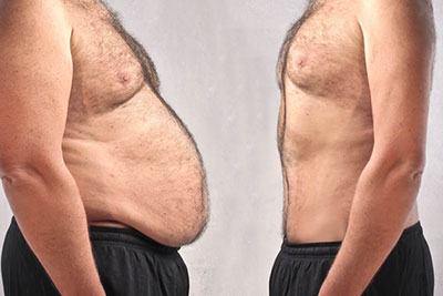 Tratamento de Obesidade São Paulo